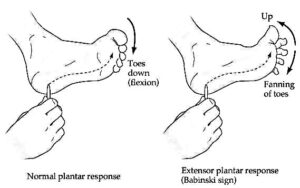 Plantar reflex - EduMedWeb